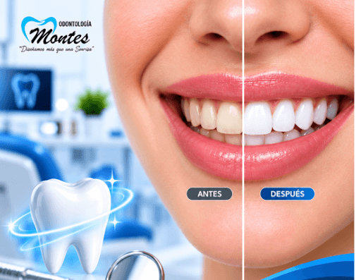 Blanqueamiento Dental Profesional
